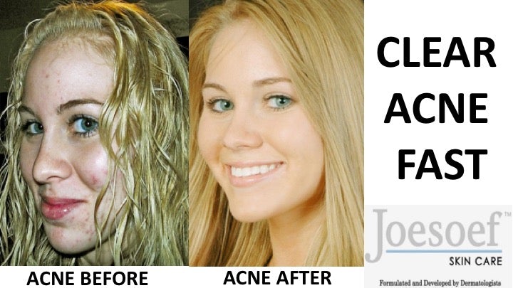 Natural Sulfur Soaps for Acne 2 Pack -Acne Soap 100G each- Joesoef Skin Care Sulfur Soap