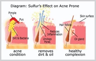 Sulfur Soap Acne Cleanser Dermatologists Approved 60 years