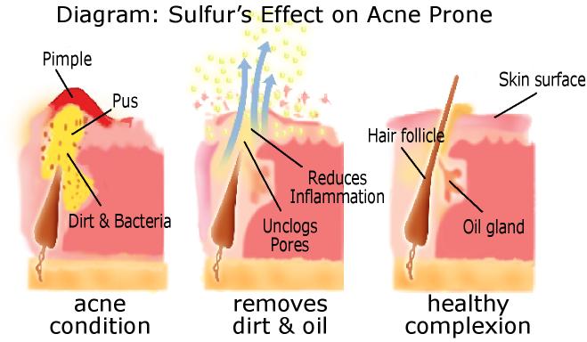 Sulfur Soap Acne Wash 3 Pack - Joesoef Skin Care Anti Acne Sulphur Soap Acne Facial Cleanser