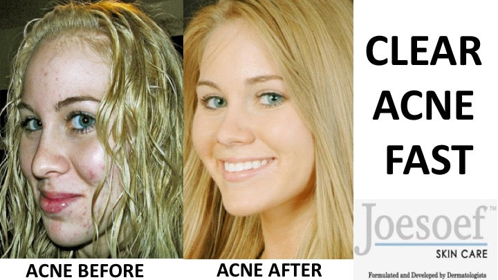 Sulfur Soap for Acne 3 Pack | Joesoef Skin Care Anti Acne Sulfur Soap